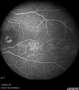 choroidal-macrovessel_116061_18.jpg
