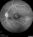choroidal-macrovessel_116061_19.jpg