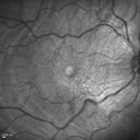 choroidalfolds_mika_092937_10.jpg