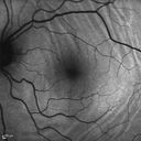 choroidalfolds_mika_092937_15.jpg