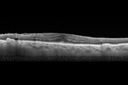 choroidalfolds_mika_092937_17.jpg