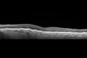 choroidalfolds_mika_092937_18.jpg