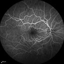 choroidalfolds_mika_092937_22.jpg