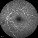 choroidalfolds_mika_092937_25.jpg