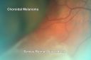 choroidalmelanomaserousrd_thas04.jpg