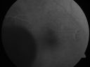 choroidalmelanomaserousrd_thas16.jpg