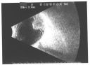 choroidalmelanomaserousrd_thas31.jpg