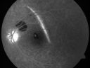 choroidalrupturechdo_28529.jpg
