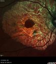 choroidalsclerosis_diwa_041316_05.jpg