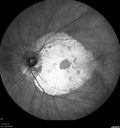 choroidalsclerosis_diwa_041316_10.jpg