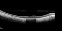choroidalsclerosis_diwa_041316_14.jpg