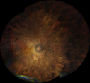 choroideremia_datib_061319_01.png
