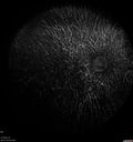 choroideremia_datib_061319_03.jpg