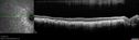 choroideremia_datib_061319_06.jpg