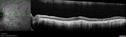 choroideremia_datib_061319_08.jpg