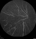 choroideremia_datib_061319_09.jpg