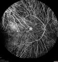 choroideremia_datib_061319_13.jpg