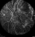 choroideremia_datib_061319_14.jpg