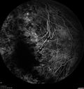 choroideremia_datib_061319_15.jpg