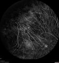 choroideremia_datib_061319_16.jpg