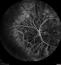 choroideremia_datib_061319_20.jpg