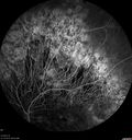 choroideremia_datib_061319_21.jpg
