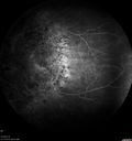choroideremia_datib_061319_22.jpg