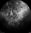 choroideremia_datib_061319_23.jpg