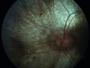 choroideremia_male_051518_05.png