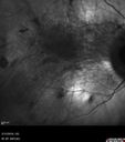 choroideremia_male_051518_08.jpg