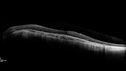 choroideremia_male_051518_12.jpg