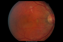 chronic-csr-laco-old_28229.png