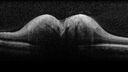 chronicPapilledema_cosp_061317_06.jpg
