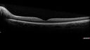 chronicPapilledema_cosp_061317_07.jpg