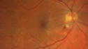 cilioretinal-artery-occl_kagro_022420_01.png