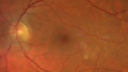 cilioretinal-artery-occl_kagro_022420_02.png