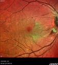 cilioretinal-artery-occl_kagro_022420_03.jpg