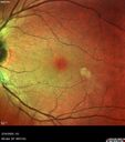 cilioretinal-artery-occl_kagro_022420_04.jpg