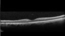 cilioretinal-artery-occl_kagro_022420_05.jpg