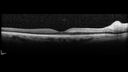 cilioretinal-artery-occl_kagro_022420_06.jpg