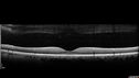 cilioretinal-artery-occl_kagro_022420_07.jpg