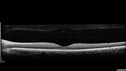cilioretinal-artery-occl_kagro_022420_08.jpg