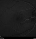 cilioretinal-artery-occl_kagro_022420_10.jpg