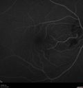 cilioretinal-artery-occl_kagro_022420_11.jpg