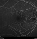 cilioretinal-artery-occl_kagro_022420_12.jpg