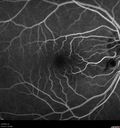 cilioretinal-artery-occl_kagro_022420_13.jpg