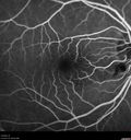 cilioretinal-artery-occl_kagro_022420_15.jpg