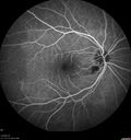 cilioretinal-artery-occl_kagro_022420_16.jpg