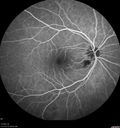 cilioretinal-artery-occl_kagro_022420_17.jpg