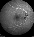 cilioretinal-artery-occl_kagro_022420_18.jpg